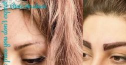 کاشت ابرو مو ریش مزوتراپی